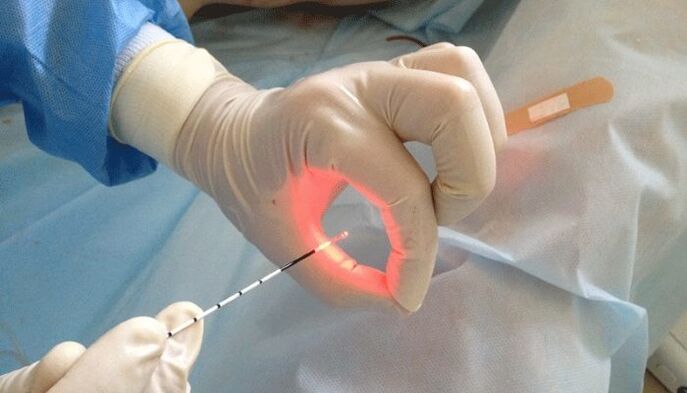 prostatiidi laserravi